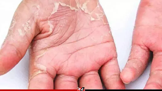 গরমে ত্বকের চামড়া ওঠার কারণ ও প্রতিকার