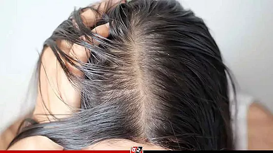 গরমে মাথার ত্বকের সংক্রমণ এড়াতে যা করবেন