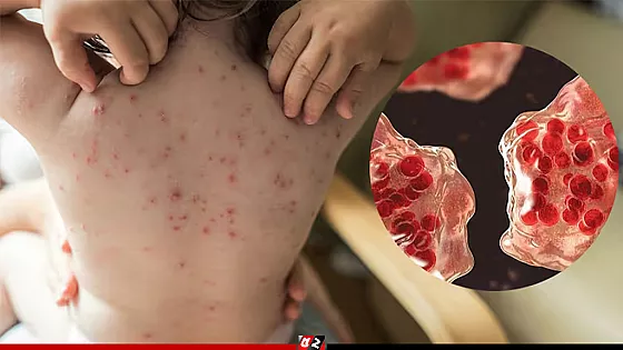 হামে আরও ৪ শিশুর মৃত্যু, আক্রান্ত ৬৮৫ জন