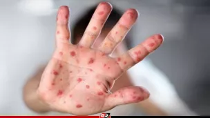 কাল থেকে শুরু হামের টিকাদান কর্মসূচি