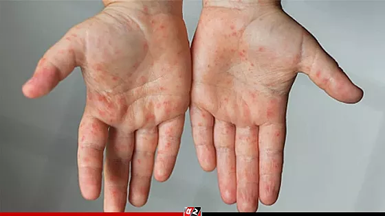 হাম ও হামের লক্ষণ নিয়ে আরও ১২ শিশুর মৃত্যু, হাসপাতালে ৬৫৪