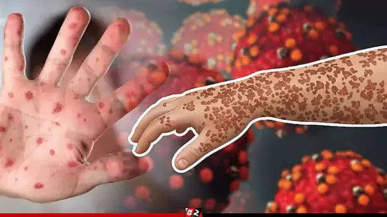 হাম ও হামের লক্ষণ নিয়ে আরও ৭ শিশুর মৃত্যু, হাসপাতালে ১২৮২ জন