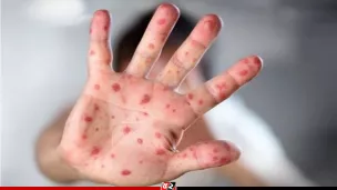 হাম ও হামের উপসর্গ নিয়ে আরও ৭ শিশুর মৃত্যু, হাসপাতালে ৬৭৪