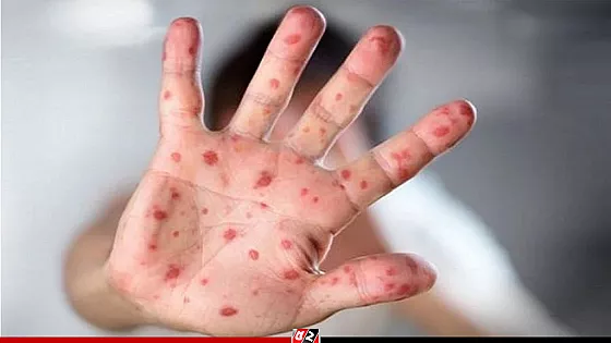 হাম ও হামের উপসর্গ নিয়ে আরও ৭ শিশুর মৃত্যু, হাসপাতালে ৬৭৪