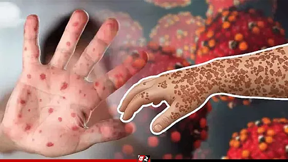 হাম ও উপসর্গ নিয়ে আরও ৭ শিশুর মৃত্যু, হাসপাতালে ৭২৯