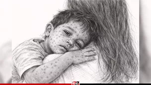 হাম ও উপসর্গ নিয়ে আরও ৯ শিশুর মৃত্যু, হাসপাতালে ১১০৫