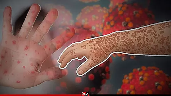 হাম ও হামের উপসর্গ নিয়ে আরও ৫ শিশুর মৃত্যু, হাসপাতালে ৭৬৯