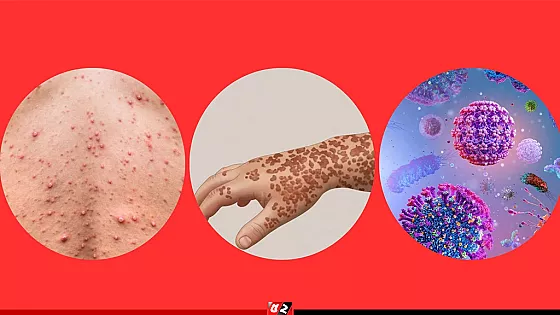 হাম ও হামের উপসর্গ নিয়ে আরও ৫ শিশুর মৃত্যু, হাসপাতালে ৮৪৭