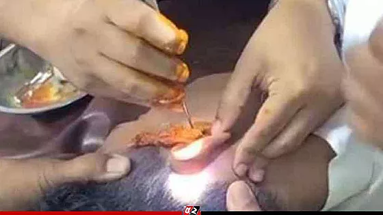 পুলিশের ভয়ে কানে ইয়াবা লুকিয়েছিল তরুণ!