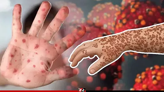 হামের উপসর্গ নিয়ে আরও ১১ শিশুর মৃত্যু, হাসপাতালে ৭৭০