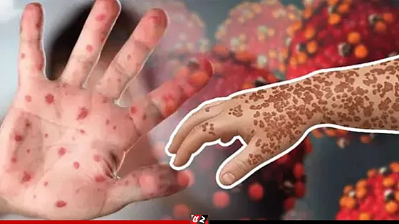 হাম ও হামের উপসর্গ নিয়ে আরও ৫ শিশুর মৃত্যু, হাসপাতালে ১০০৮