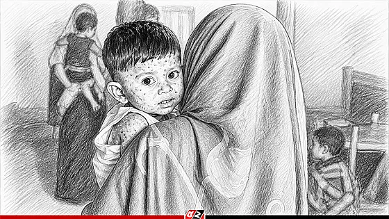 হাম ও উপসর্গে আরও ৮ শিশুর মৃত্যু, হাসপাতালে ১১৭৩