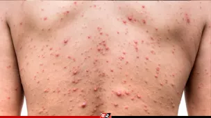 হাম ও উপসর্গে আরও ১৭ শিশুর মৃত্যু