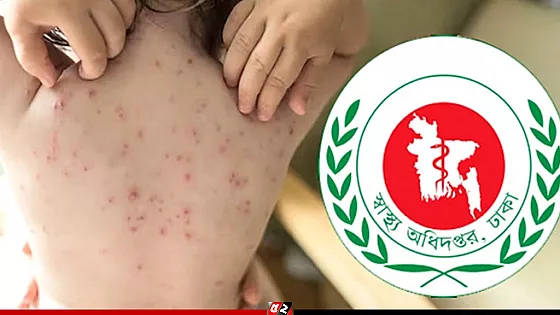 হামের উপসর্গে আরও ৮ শিশুর মৃত্যু, হাসপাতালে ৯০৭