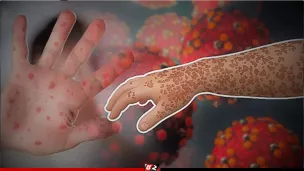 হামের উপসর্গ নিয়ে আরও ২ শিশুর মৃত্যু 