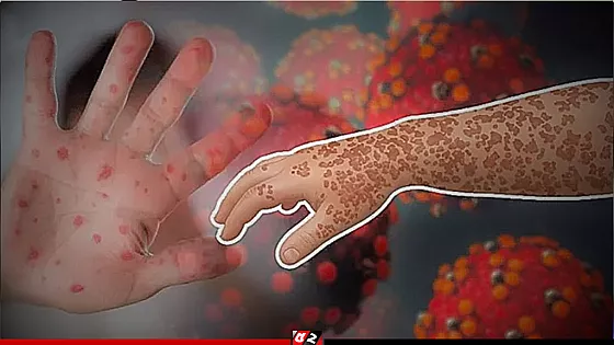হামের উপসর্গ নিয়ে আরও ২ শিশুর মৃত্যু 