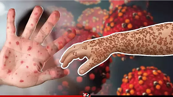হামের উপসর্গে আরও ৩ শিশুর মৃত্যু, হাসপাতালে ৯৩৩