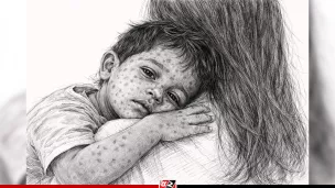 হামের উপসর্গে আরও ৫ শিশুর মৃত্যু, হাসপাতালে ৬৭২