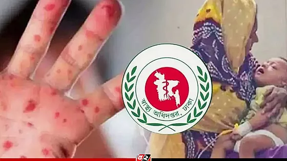 হাম ও উপসর্গে আরও পাঁচ শিশুর মৃত্যু     