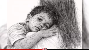 হামের উপসর্গে আরও ৪ শিশুর মৃত্যু, হাসপাতালে ১২১৮