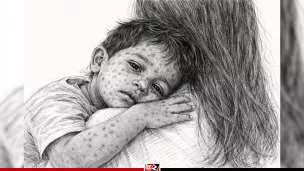 হামের উপসর্গ নিয়ে আরও ২ শিশুর মৃত্যু, হাসপাতালে ৮১২
