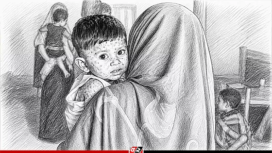 হামের উপসর্গে আরও ৫ শিশুর মৃত্যু, মোট প্রাণহানি ৯৪৩