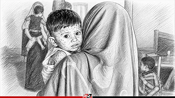 হাম ও উপসর্গে মৃতের সংখ্যা হাজার ছাড়াল, একদিনে ৩   