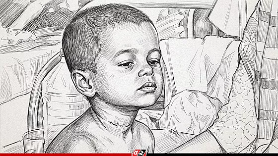 হামের উপসর্গে আরও ৫ জনের মৃত্যু, আক্রান্ত ১২১০