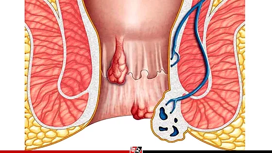 পাইলস কেন হয়? জেনে নিন এর প্রতিকার